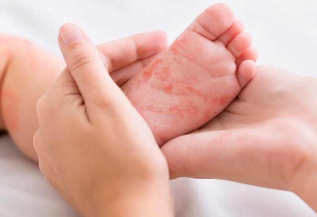 Уголовное дело возбудили после заражения ребенка корью в детской больнице Красноярска